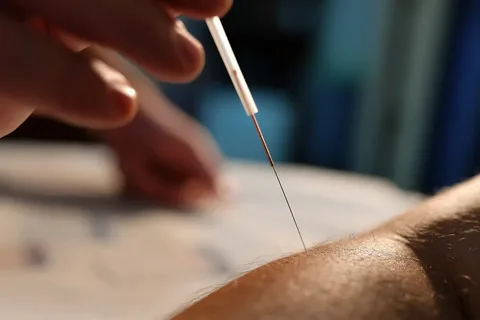 Dry needling Melbourne