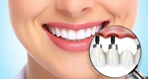 Expert Dental Implants Alexandria – Restore Your Confidence today