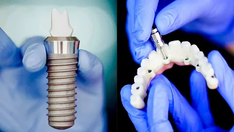 Dental implants Leichhardt